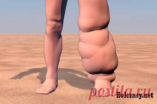 Слоновость ног. Признаки, причины и народные способы лечения Слоновость или элефантиаз, это увеличение параметров некоторых частей тела, которые происходят из-за гиперплазии кожи. Возникает застой лимфы, вызывающий отёк участка тела. Для этого процесса характерна устойчивость, то есть, отёк со временем не уменьшится.