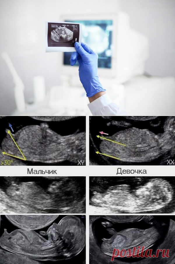 Узи 16 недель беременности мальчик. Могут ли ошибаться узисты с полом. Могут ли ошибаться узисты с полом. Узи мальчик или девочки. Пол ребенка на узи.