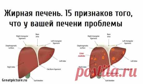 Жирная печень.15 признаков того, что у вашей печени проблемы Жирная печень.15 признаков того, что у вашей печени проблемы.Это состояние возникает, когда ваше тело имеет слишком много жира и не может