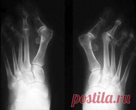 Что такое Халюс вальгус?