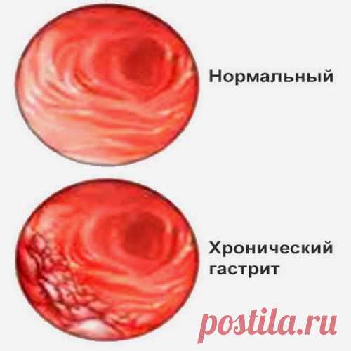Травяная каша | Друг пенсионера
Как-то раз обострился у меня га­стрит. Лечение известными нам лекарствами ничего не дало. Боль исчезала лишь на время, а ночью возобновлялась. Спасение пришло вместе с советом знакомого, он дал нам рецепт овсяной каши с травами.