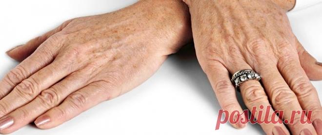 Как удалить пигментные пятна на руках — Полезные советы