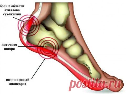 Эффективное лечение пяточной шпоры