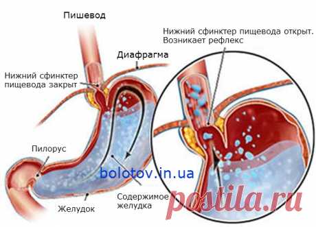 Изжога. Лечение и причины изжоги | Лечение заболеваний