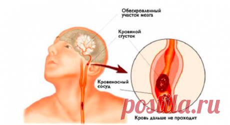 Инсульт: Запомните всего 3 первых шага, чтобы спасти себе и близким жизнь 
Сперва короткая история:
Во время отдыха на природе, молодая девушка вдруг резко остановилась и свалилась на землю. Отдыхающие хотели оказать помощь, но она удостоверила абсолютно всех, что чувствует…