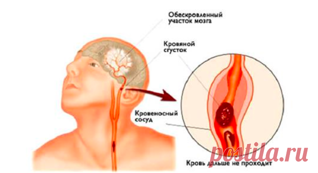 Инсульт: Запомните всего 3 первых шага, чтобы спасти себе и близким жизнь 
Сперва короткая история:
Во время отдыха на природе, молодая девушка вдруг резко остановилась и свалилась на землю. Отдыхающие хотели оказать помощь, но она удостоверила абсолютно всех, что чувствует…