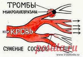 Удаляем тромбы луком