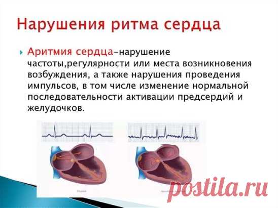 КАК ПОМОЧЬ СЕБЕ ПРИ АРИТМИИ
Экстрасистолия - наиболее часто встречающаяся форма сердечных аритмий. Она может возникать не только в результате сердечных недугов, но и при заболеваниях желудочно-кишечного тракта, мочеполовой системы, остеохондрозе позвоночника, эндокринных нарушениях.
Причиной возникновения экстрасистолии (даже у здорового человека) может быть стресс, переутомление, злоупотребление лекарствами, кофе, курением, алкоголем.
Основными симптомами болезни являются «замирание сердца»,