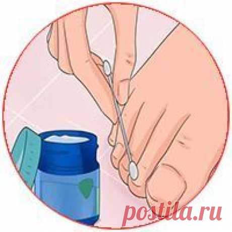 18 способов победить грибок ногтей
