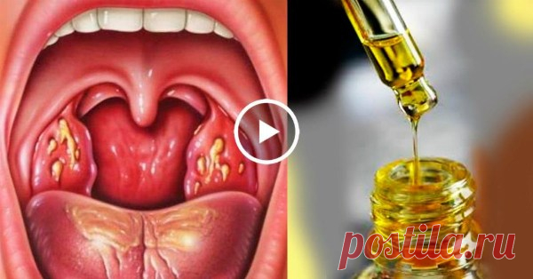 У вас часто болит горло, пропадает голос и мучает кашель? Избавься от этих проблем за 1 ночь, просто и легко! — Копилочка полезных советов