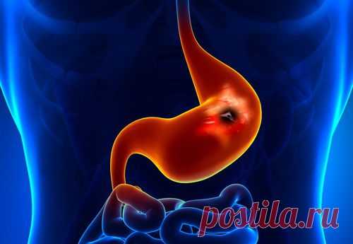Síntomas de una posible úlcera gastroduodenal: ¡Conócelos! - Mejor Con Salud