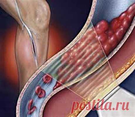 ТРОМБОЗ ГЛУБОКИХ ВЕН / Популярная медицина