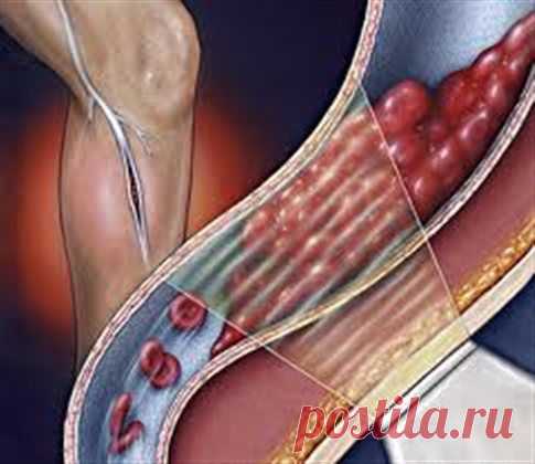 ТРОМБОЗ ГЛУБОКИХ ВЕН / Популярная медицина