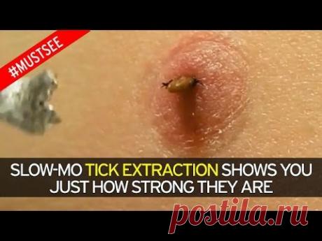 Чтобы вытащить клеща из ноги, используйте лишь один предмет