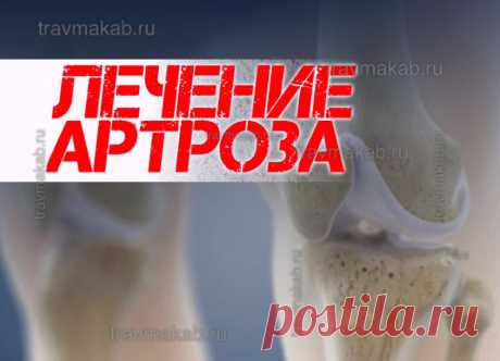 Лечение артроза (остеоартроза, ОА): таблетки, мази, уколы, тактика лечения, схемы лечения артроза | Врач травматолог-ортопед, онлайн кабинет