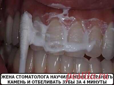 ЖЕНА СТОМАТОЛОГА НАУЧИЛА МЕНЯ УСТРАНЯТЬ ЗУБНОЙ КАМЕНЬ И ОТБЕЛИВАТЬ ЗУБЫ ЗА 4 МИНУТЫ