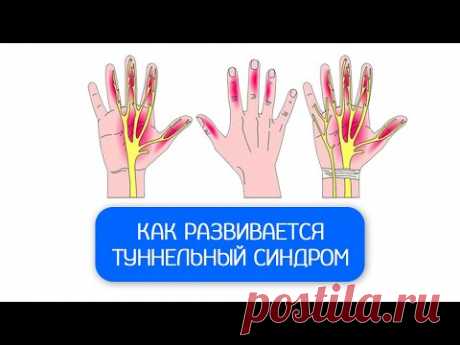 Синдром карпального канала - операция не поможет!