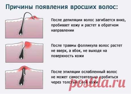 Чтобы волосы на ногах не врастали