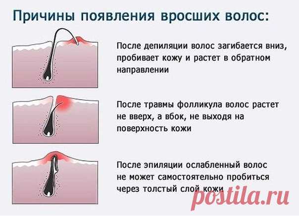 Чтобы волосы на ногах не врастали