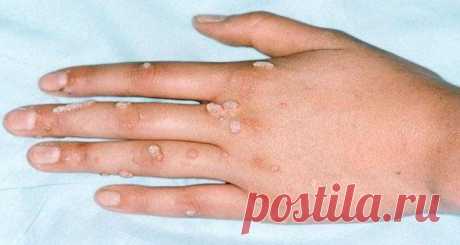 3 оксолиновая мазь от папиллом отзывы, инструкция по применению, аналоги