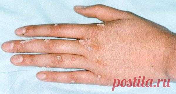 3 оксолиновая мазь от папиллом отзывы, инструкция по применению, аналоги