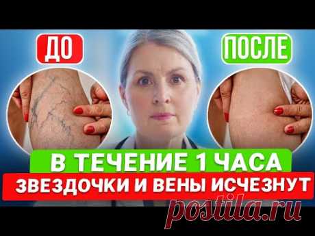 Флеболог: попробуйте, Это удаляет расширение Вен и сосудистые Звёздочки (важно)