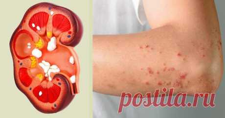 8 безошибочных признаков того, что твои почки не в порядке.