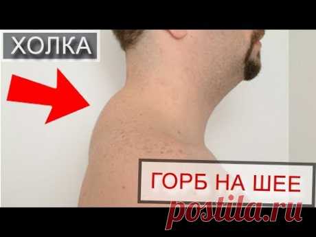 Холка на шее - вдовий горбик (гормональный горбик, климактерический, эстетический). Радион Игнатьев
