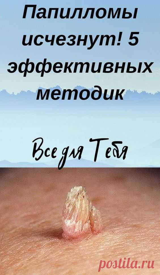 Папилломы исчезнут! 5 эффективных методик