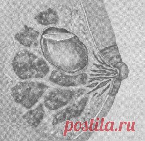 Киста молочной железы: симптомы, причины и лечение. Народные средства.