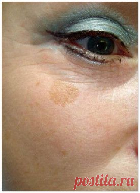 Возрастная пигментация, причины, как избавиться | Яблочко молодильное