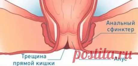 Симптомы и особенности лечения заболеваний прямой кишки