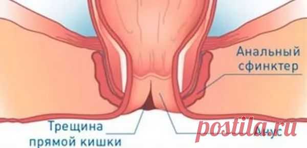 Симптомы и особенности лечения заболеваний прямой кишки