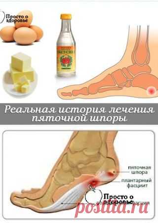 пяточная шпора,боли ступней