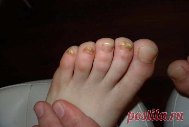 Простой рецепт от грибка на ногах | Евгения Селезнёва | Яндекс Дзен