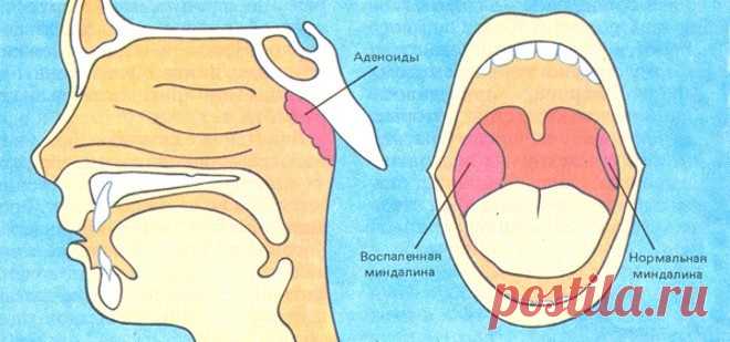 «ПОЗА ЛЬВА» — УПРАЖНЕНИЕ ДЛЯ ОЧИЩЕНИЯ МИНДАЛИН.