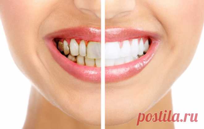 4 смеси, которые полностью удаляют зубной камень Зубной налет обычно формируется над линией десны и под ней. В дальнейшем он превращается в зубной камень, что приводит к заболеваниям десен. Большинство людей хотят сверкающие белые зубы – так они выг…