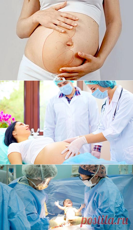 Рекомендации после кесарева. Кесарево сечение реабилитация. Общий наркоз при кесаревом сечении. Разрез кесарева сечения. Сколько можно после кесарево родить ребенка.