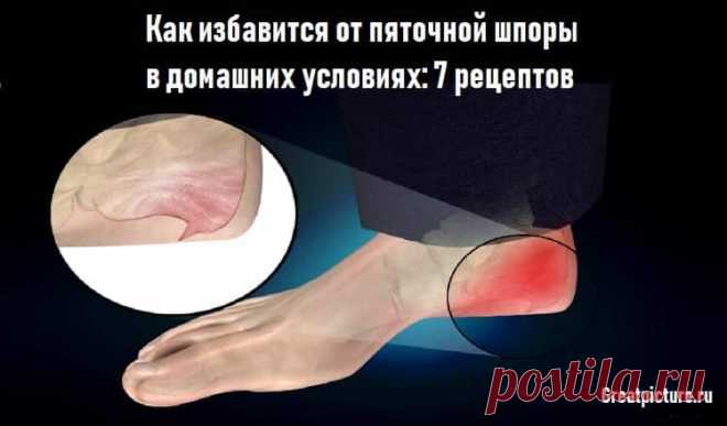 Как избавится от пяточной шпоры в домашних условиях: 7 рецептов 
 Как избавится от пяточной шпоры в домашних условиях: 7 рецептов.Не надо терпеть 👌.Избавляемся от шпор без хирургии и лекарств.
Пяточную шпору вызывают осадки кальция, которые приводят к костному нар…