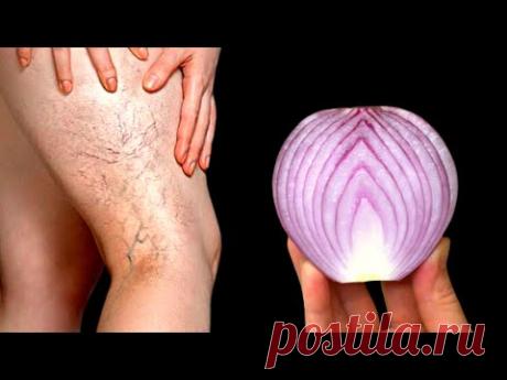 Невероятно!🤩Это убийца варикоза! Стирает варикоз как резинка!