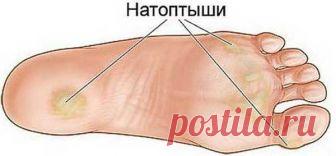Простые способы, которые помогут избавиться от натоптышей, мозолей, трещин, варикоза и сосудистой сетки!