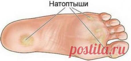 Простые способы, которые помогут избавиться от натоптышей, мозолей, трещин, варикоза и сосудистой сетки!