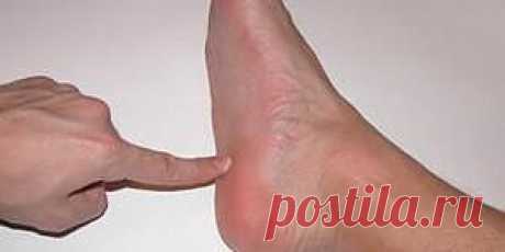 (+1) тема - Симптомы пяточной шпоры | Первая помощь