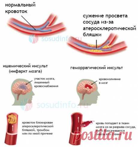 Сужение сосудов головного мозга: симптомы, лечение, причины