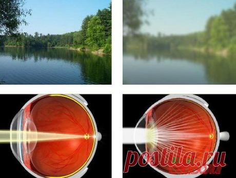 Народные средства лечения катаракты