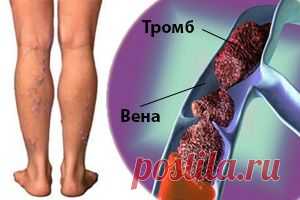 Тромбоз подколенной вены: симптомы, диагностика, лечение