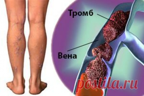 Тромбоз подколенной вены: симптомы, диагностика, лечение