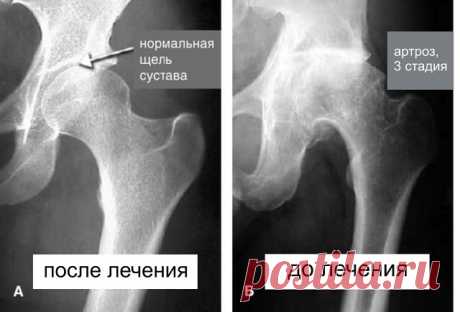 Сегодня хирургическая практика отходит на второй план. Суставы стало возможным ЛЕЧИТЬ, а не резать! Уникальность заключается в том, что теперь можно выращивать и обновлять ткани суставов, которые вышли из строя: хрящевую выстилку, сухожилия, мышцы, смазочную жидкость. Отказ от костылей и колясок, способность передвигаться без сопровождения и быстрота достижения результатов - рекордные показатели лечения, которые подтверждены на практике. 

Выдержка из публикации выступлени...