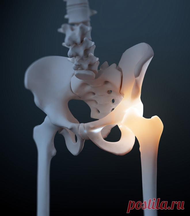 Лечение деформации шейки бедра в Германии