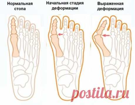 «Вальгусная деформация большого пальца стопы: лечение в Москве  Из-за ношения неудобной обуви происходят изменения в переднем отделе стопы и проявляются ростом «косточки» и искривлением большого пальца. Комплексный подход к каждому пациенту позволяет нам достигнуть отличных эстетических и функциональных результатов в лечении данной болезни. Операции проводятся на ультрасовременном оборудовании с использованием качественных расходных материалов и имп...